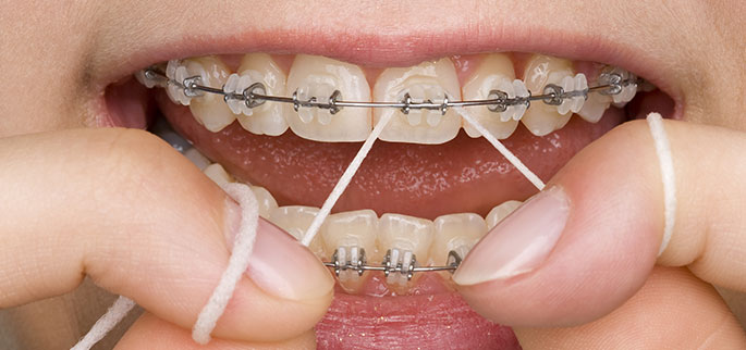 Cuidados com Aparelhos Fixos