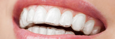 Invisalign - passo 4